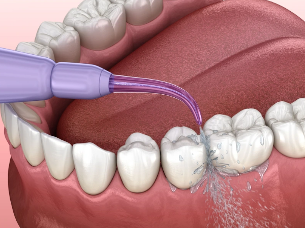 Which is more effective, oral irrigator before or after bruising?