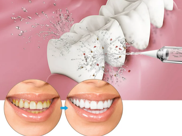 How an oral irrigator can help with periodontitis?