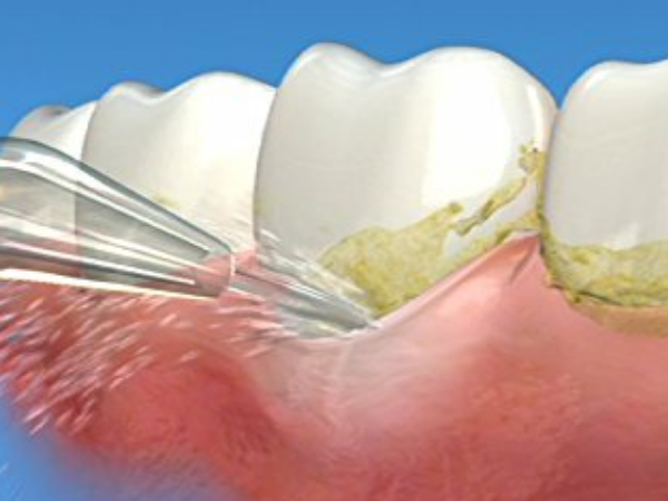 Can water flosser damage gums?